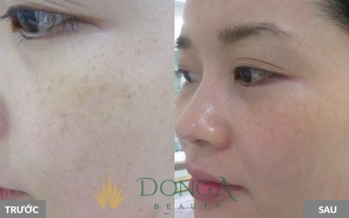 Đặc trị nám cấp độ 1 bằng công nghệ Yellow Laser Hoa Kỳ
