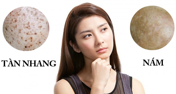 Tổng hợp các thông tin phân biệt Nám và Tàn nhang