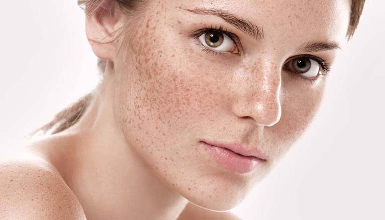 Những biến chứng có thể xảy ra khi trị nám sai cách