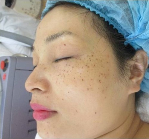 khách hàng trị nám ngày đầu