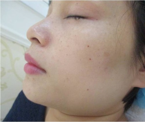 khách hàng trị nám sau 7 ngày