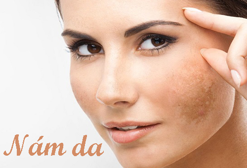 Nám có thật sự “ĐÁNG SỢ”? Những dấu hiệu của nám da bạn cần biết