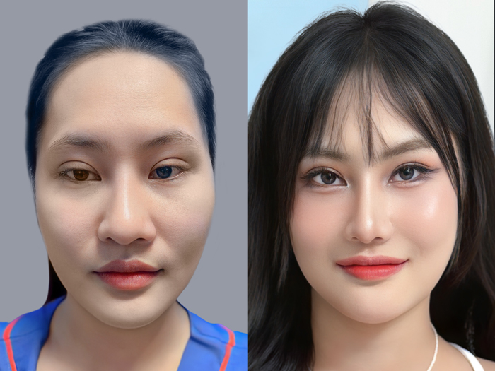 Tham khảo ảnh thật của khách hàng đã từng thẩm mỹ tại cơ sở đó