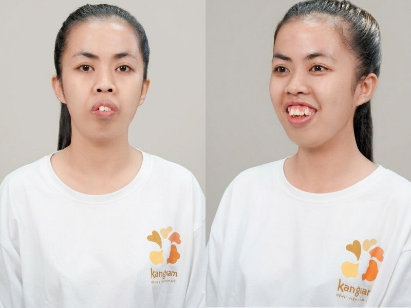 Trà My sở hữu khuyết điểm hàm hô nặng, răng mọc lộn xộn, mí mắt không đều và dáng mũi thấp