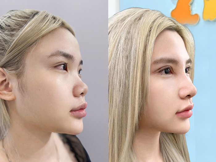 Kết quả khách hàng sau khi thực hiện nâng mũi tại Kangnam