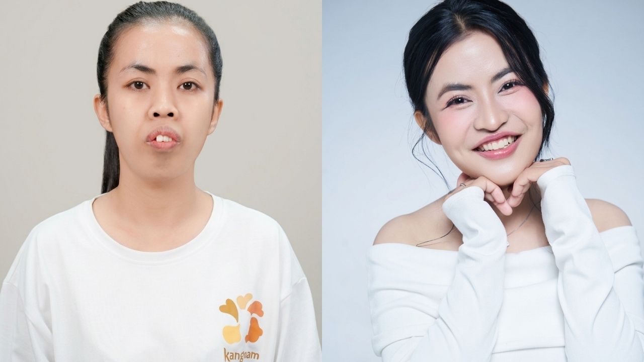 Trà My trước và sau phẫu thuật tại Hành trình Lột xác mùa 7